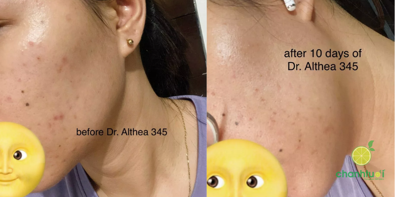 Trước và sau 10 ngày dùng kem dưỡng 345 Relief Cream