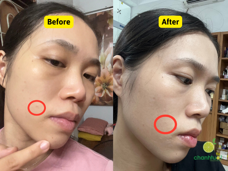 Vitapair C Nature Republic trị thâm
