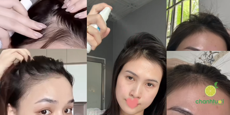 XỊT MỌC TÓC MINOXIDIL hiệu quả