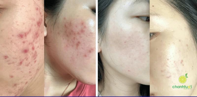 Da nhiễm Corticoid 6