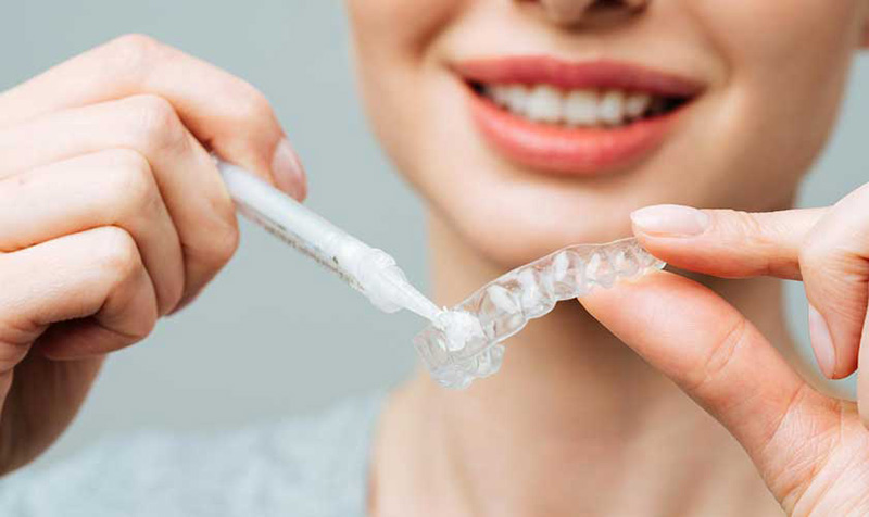các-phương-pháp-tẩy-trắng-răng-4