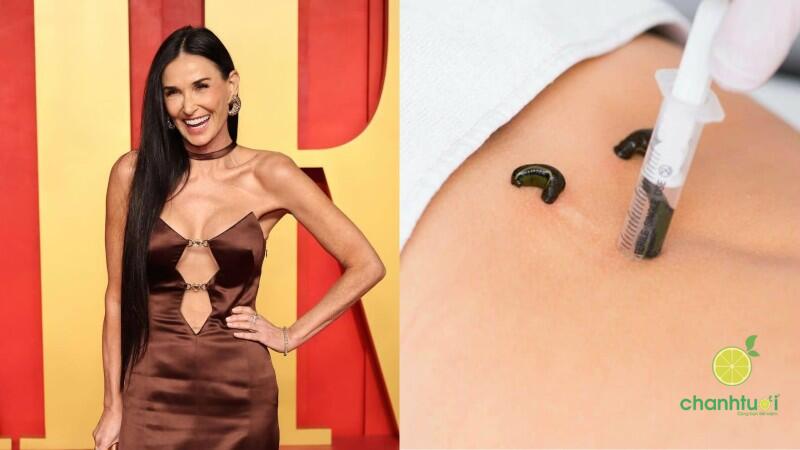 liệu pháp đỉa 2