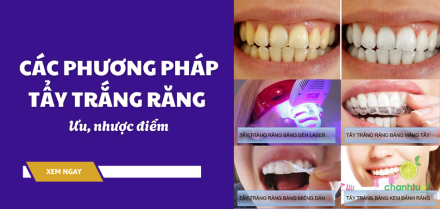 Ưu, nhược điểm của các phương pháp tẩy trắng răng hiện nay
