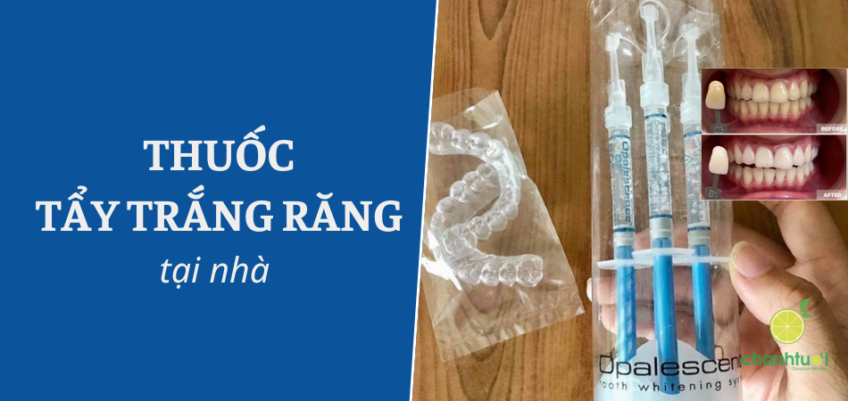 Thuốc tẩy trắng răng tại nhà tốt nhất