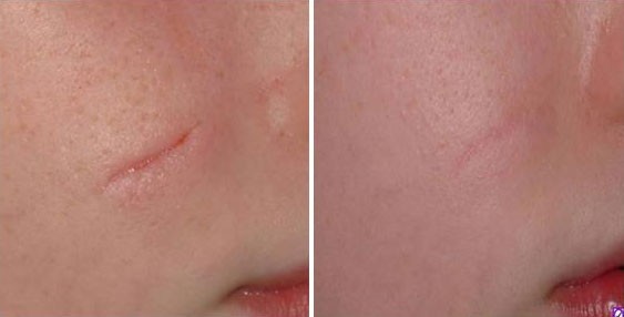 kem trị sẹo lõm