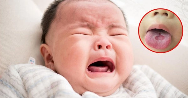 bệnh thường gặp ở trẻ sơ sinh
