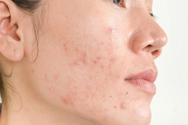 cách trị mụn ẩn