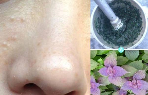cách trị mụn cám