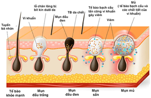 kem trị mụn cho nam
