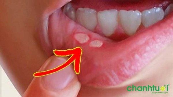 Cách chữa nhiệt miệng