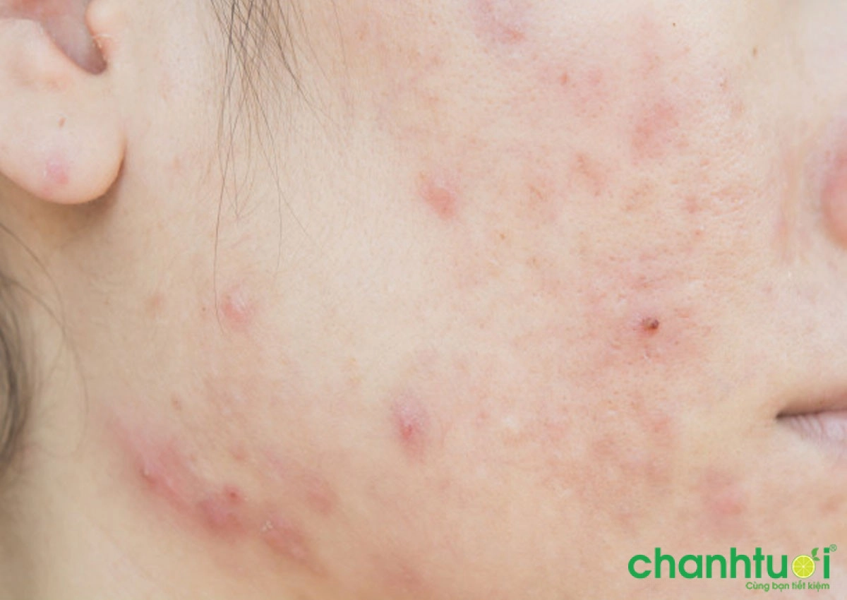 Huyết thanh-Vitamin C: