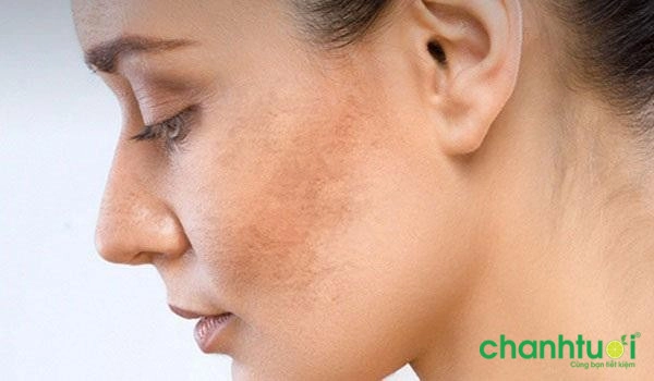 Huyết thanh-Vitamin C: