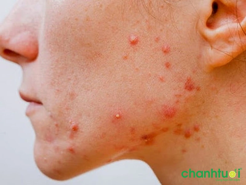 cách điều trị mụn viêm sưng