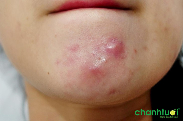 cách điều trị mụn viêm sưng