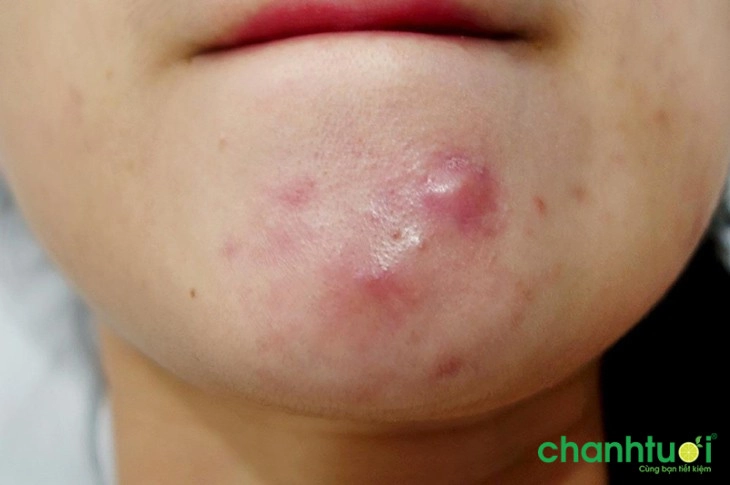 cách điều trị mụn viêm sưng