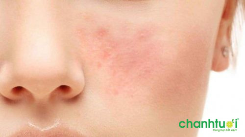 cách điều trị mụn viêm sưng