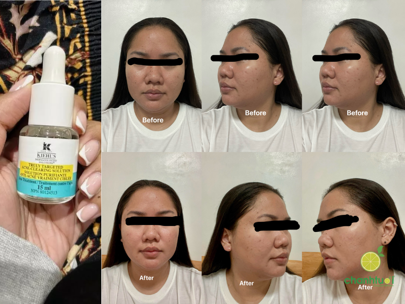 chấm mụn kiehl's (3)