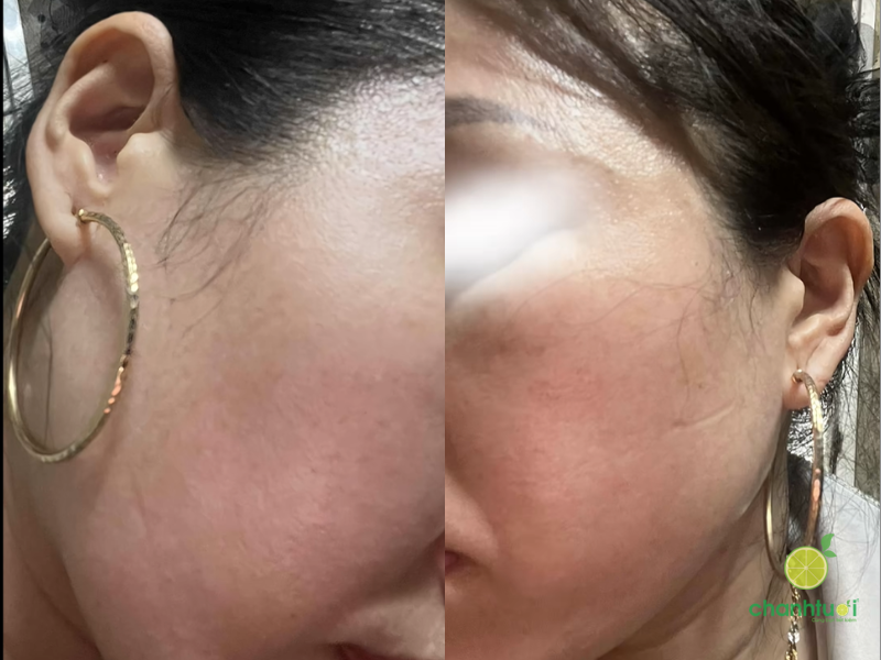 kem trị nám spotlite (1)