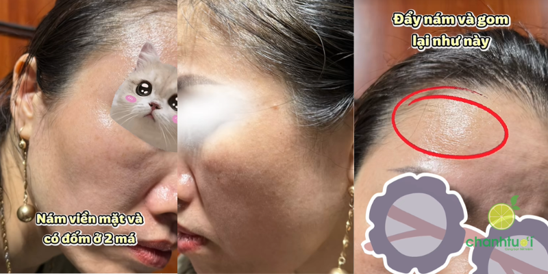 kem trị nám spotlite