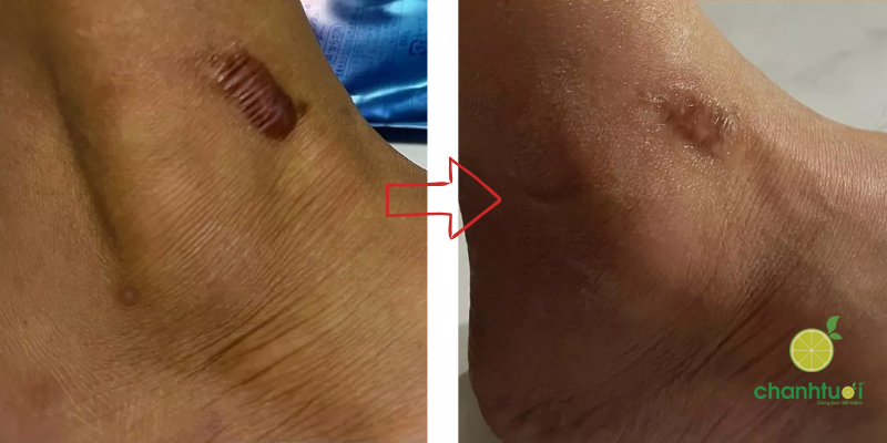 kem-tri-seo-actiscar-2