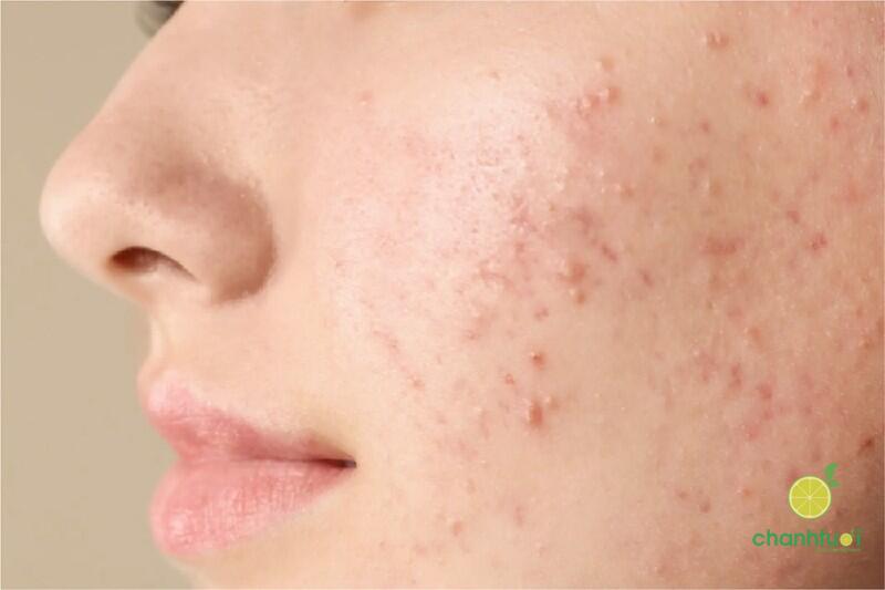 kết hợp Azelaic Acid với Retinol-1