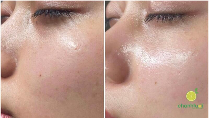 kết hợp Azelaic Acid với Retinol (3)